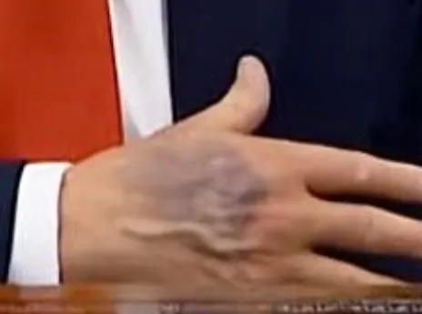 HAND